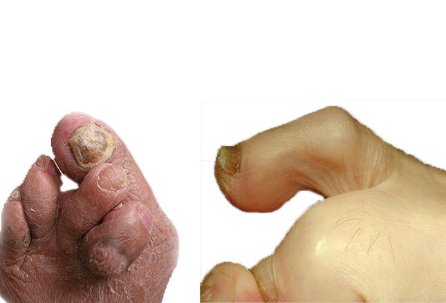 заболевания стопы, Молоткообразные и когтеобразные деформации пальцев.