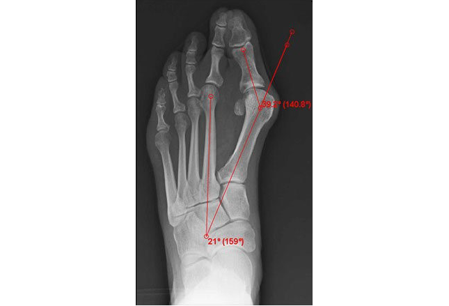 заболевания стопы, Вальгусная деформация 1 пальца стопы.