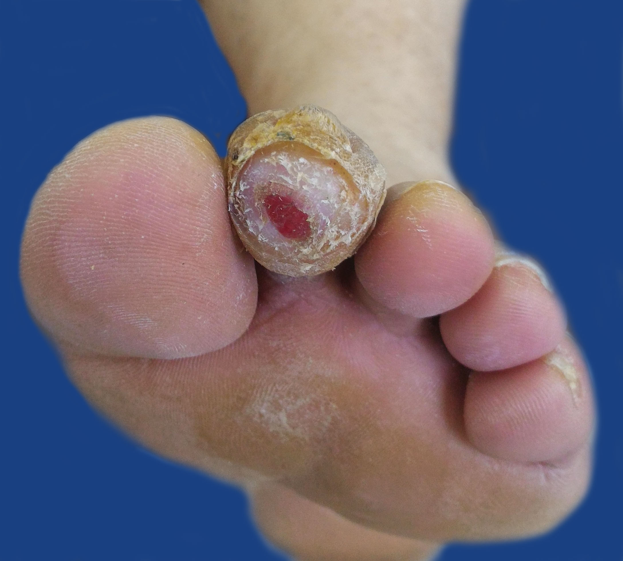 Водянистые волдыри на ногах при диабете thumbnail