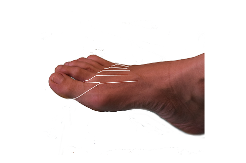 Ампутация пальца ноги болит